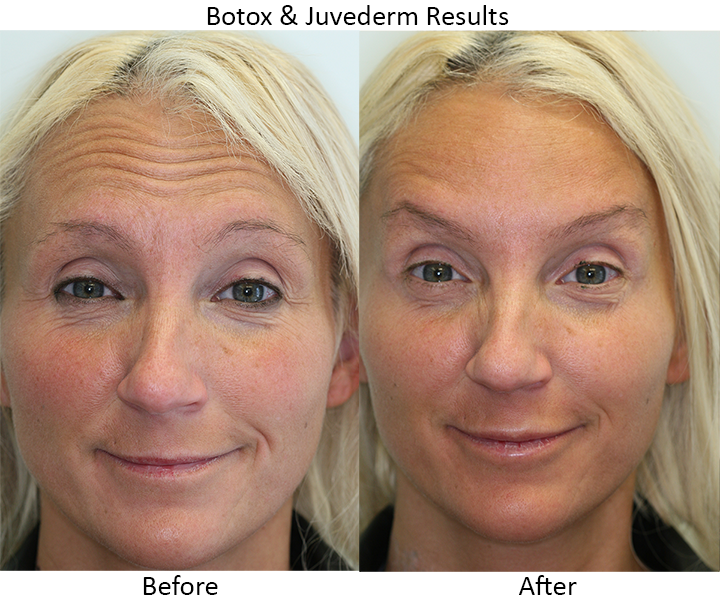 Botox & Juvederm Results #2