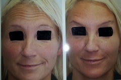 Botox & Juvederm Results #3