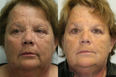 Botox & Juvederm Results #1