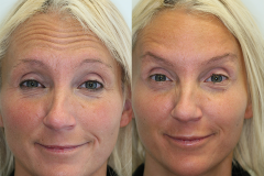 Botox & Juvederm Results #2